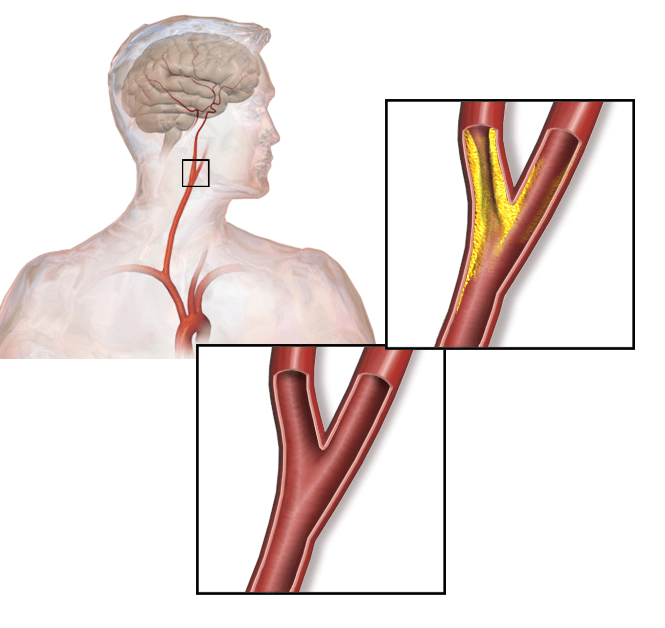 atherosclerotic plaque